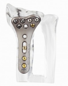 Implantat zur Knochenverbindung bei Armfrakturen.
